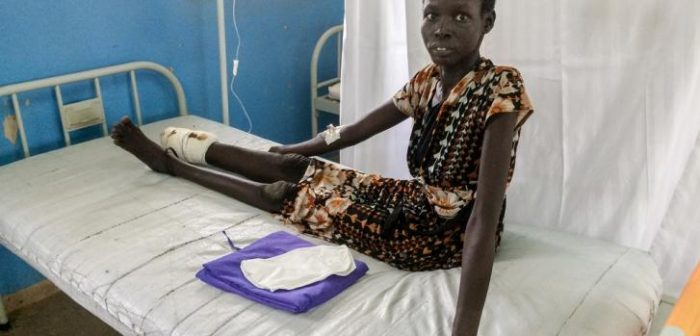 Nyekuony tiene 36 y perdió su pie y parte de su pierna debido a una mordedura de serpiente que no fue tratada a tiempo. Acá está en nuestro hospital en Agok, Sudán del Sur. ©Alexandra Malm/MSF