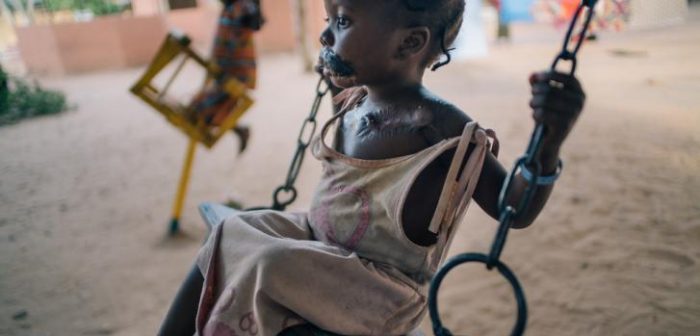 Maryam tiene cuatro años y juega en el patio del Hospital Sokoto Noma. Es una de las pocas personas que sobreviven a la enfermedad.Claire Jeantet - Fabrice Caterini/INEDIZ