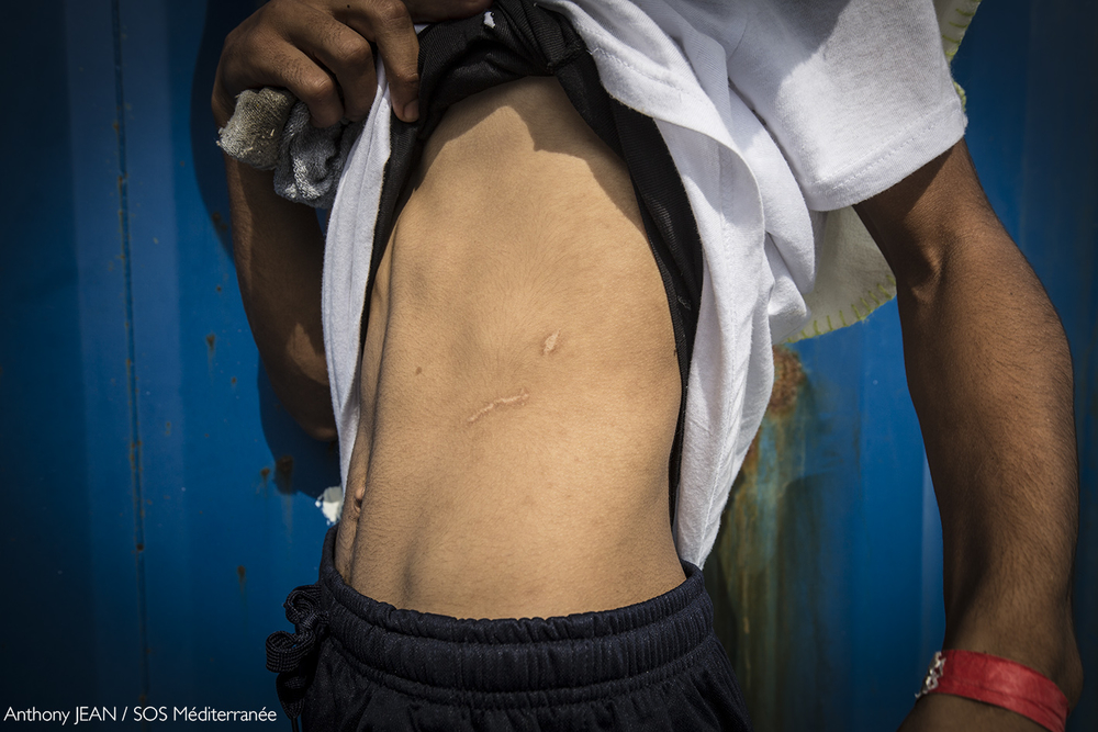 Imagen de archivo de 2017: Un hombre muestra una cicatriz que le infligieron en los centros de detención en Libia © Anthony Jean/SOS MEDITERRANEE.